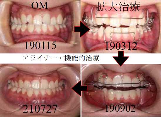 アライナー治療例